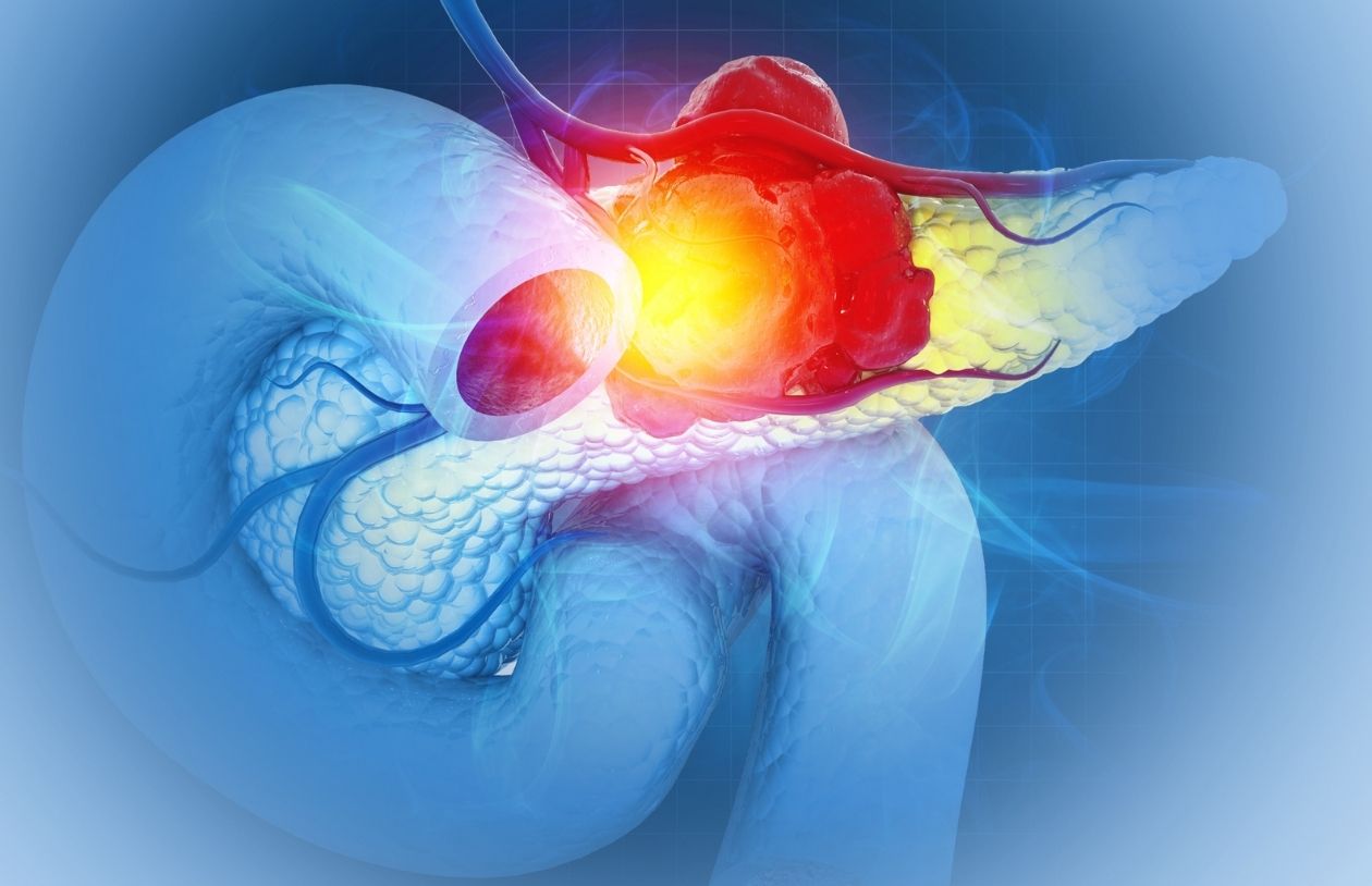 Pancreas with a highlighted red tumor and surrounding inflammation, depicting pancreatic cancer progression.
