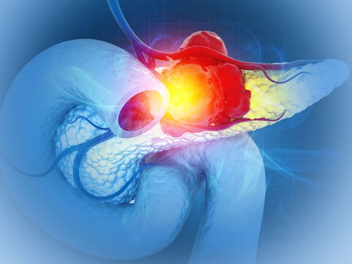 Pancreas with a highlighted red tumor and surrounding inflammation, depicting pancreatic cancer progression.