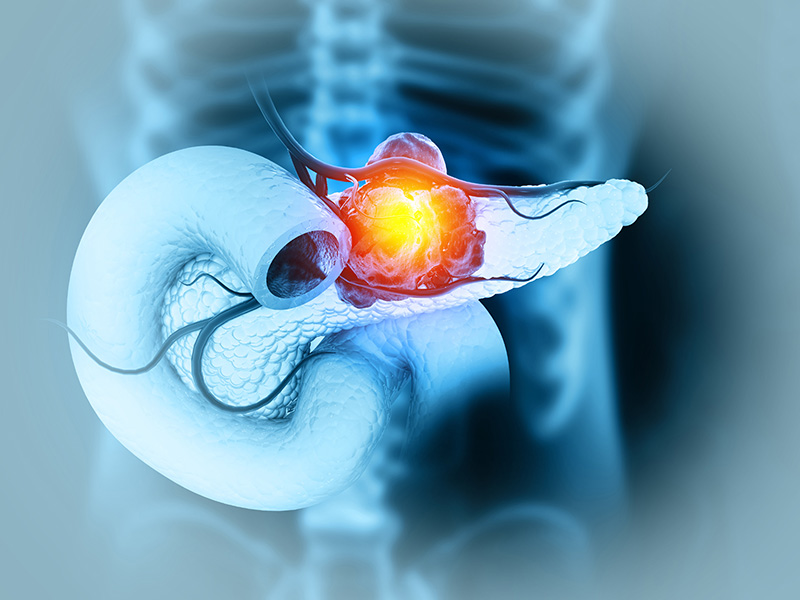 pancreatic cancer